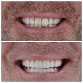 before-after photo no-prep-veneers