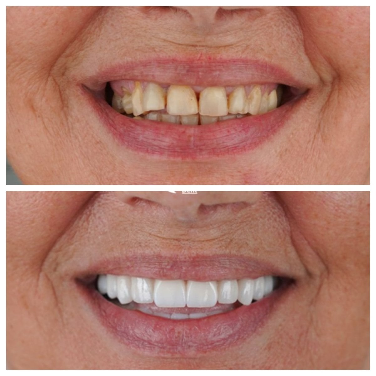 Resultados antes y después de carillas sin tallado en Nifa Dent International, transformación de sonrisa