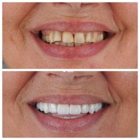 before-after photo no-prep-veneers