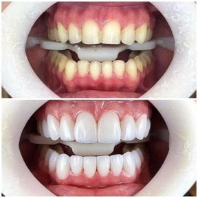 before-after photo emax-veneers
