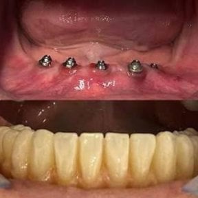 Before and after dental implant results at Punta cana dentist odontologia familiar, full arch restoration