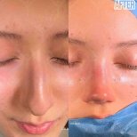 نتائج عملية تجميل الأنف قبل وبعد في HayatMed Clinic، تحسين شكل الأنف