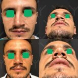 نتائج عملية تجميل الأنف قبل وبعد في HayatMed Clinic، تحسين شكل وتناسق الأنف