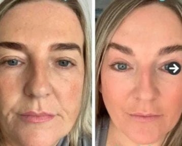 before-after photo blefaroplastika-korrekciya-vek