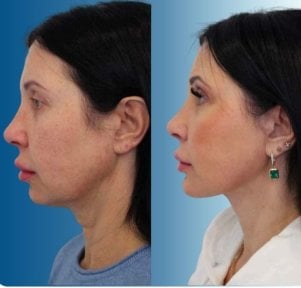 before-after photo blefaroplastika-korrekciya-vek
