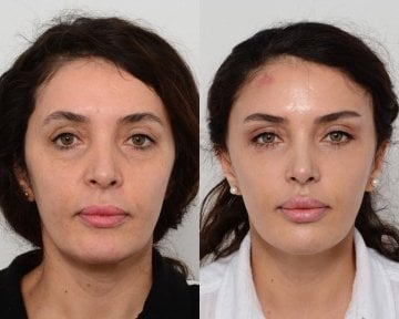 before-after photo blefaroplastika-korrekciya-vek