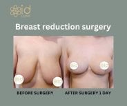Resultados antes y después de reducción de senos en ID Clinic Bangkok, cambio visible