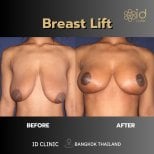 Resultados antes y después de mastopexia en ID Clinic Bangkok, mejor forma y firmeza
