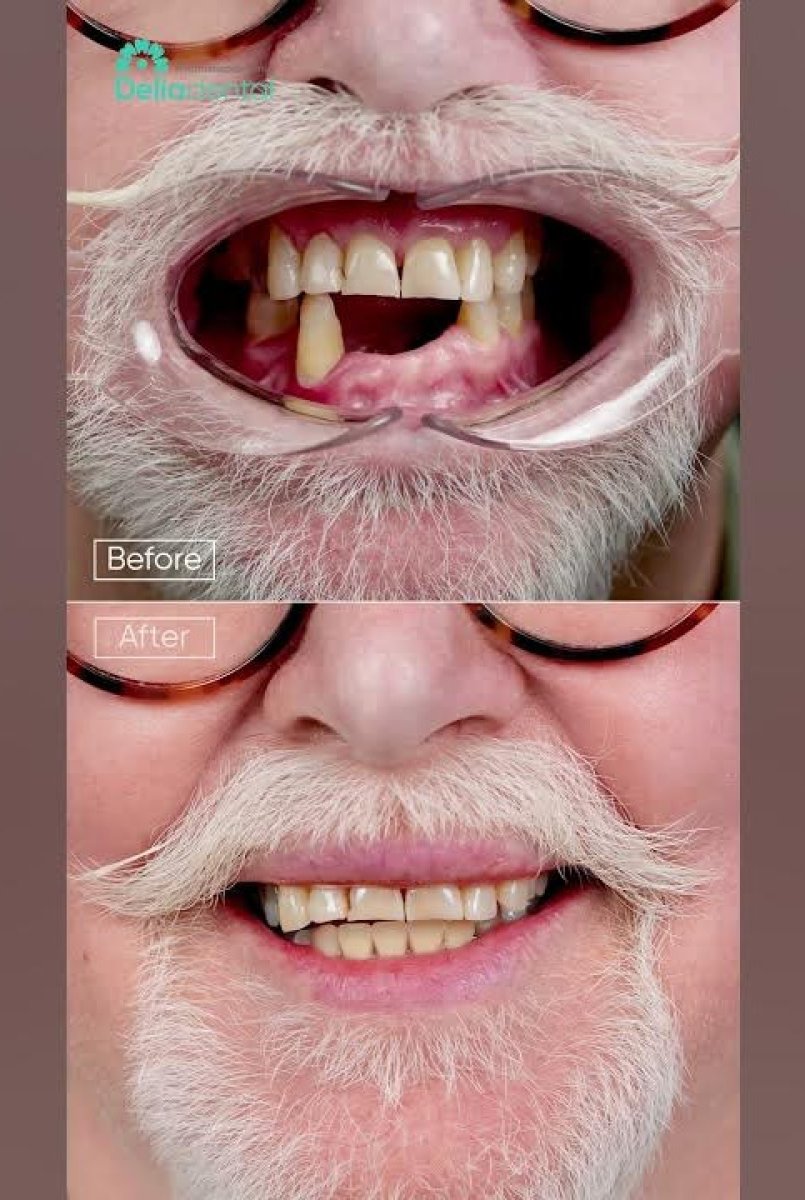 نتيجة قبل وبعد زراعة الأسنان All-on-4، ابتسامة مستعادة في عيادة Dentaesthetic
