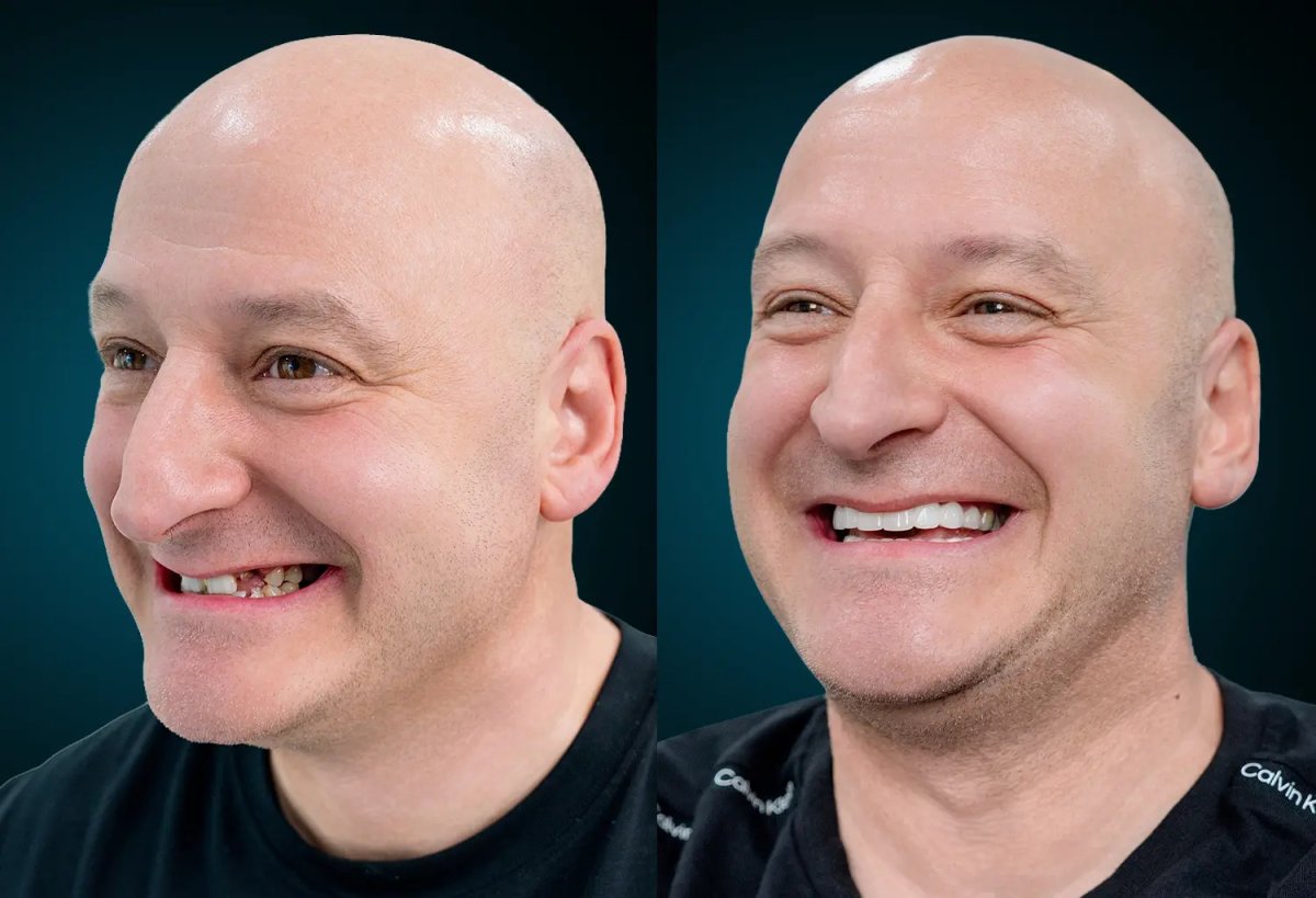 Resultado antes y después de smile makeover: dientes alineados y sonrisa más blanca