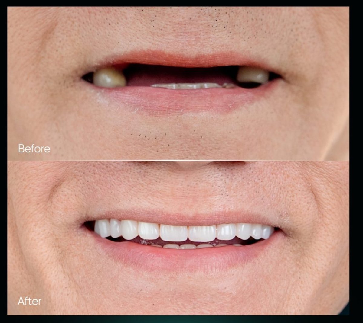 Resultados de implantes dentales antes y después: sonrisa restaurada con dientes naturales