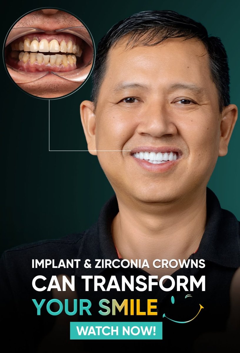 Resultados antes y después de coronas de zirconia e implantes: transformación de sonrisa