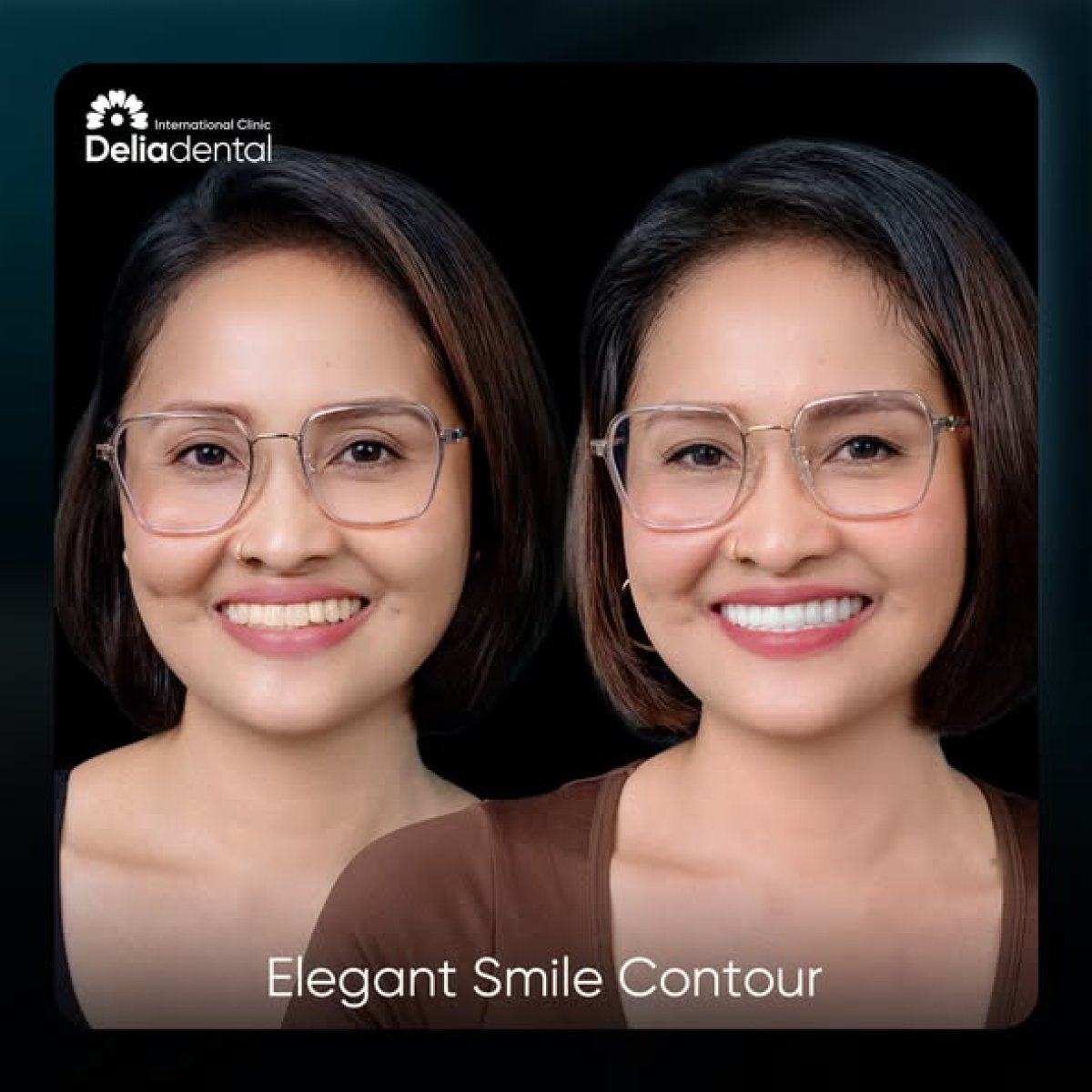نتائج قبل وبعد تركيب تيجان الزركونيا في Deliadental – تحسين جمالية الابتسامة