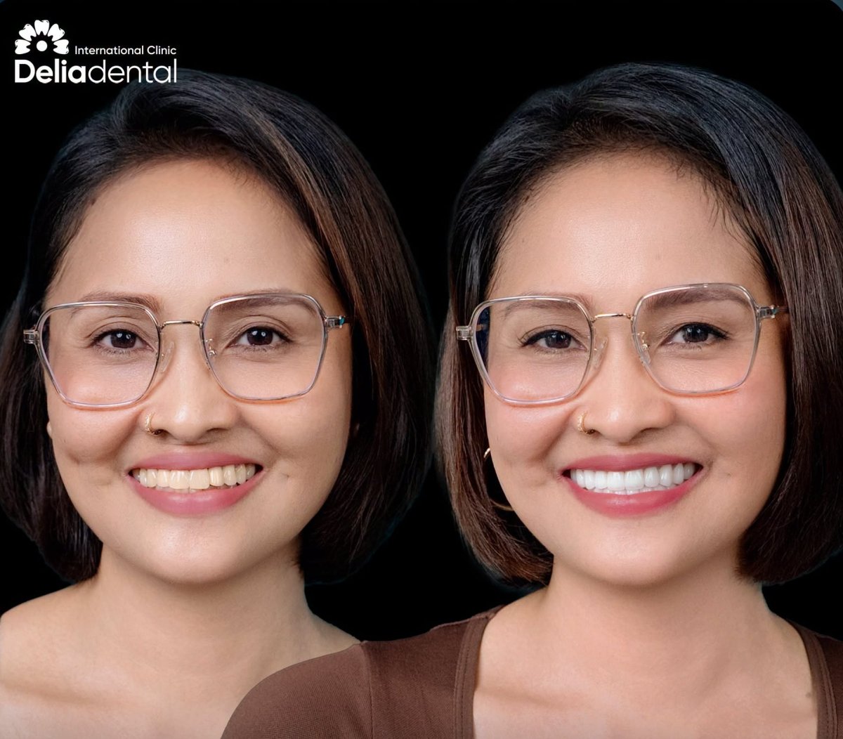 نتائج تبييض الأسنان قبل وبعد في عيادة Deliadental – ابتسامة أكثر إشراقًا