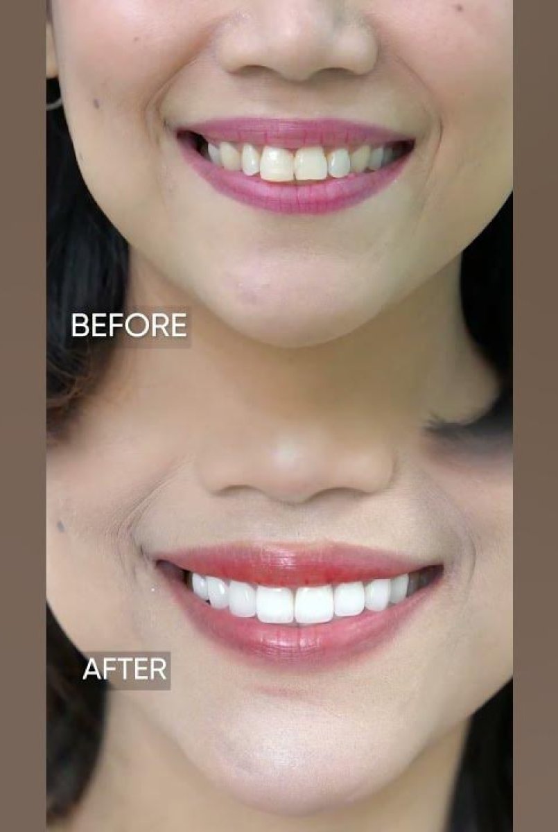 Resultados de blanqueamiento dental antes y después: sonrisa visiblemente más brillante