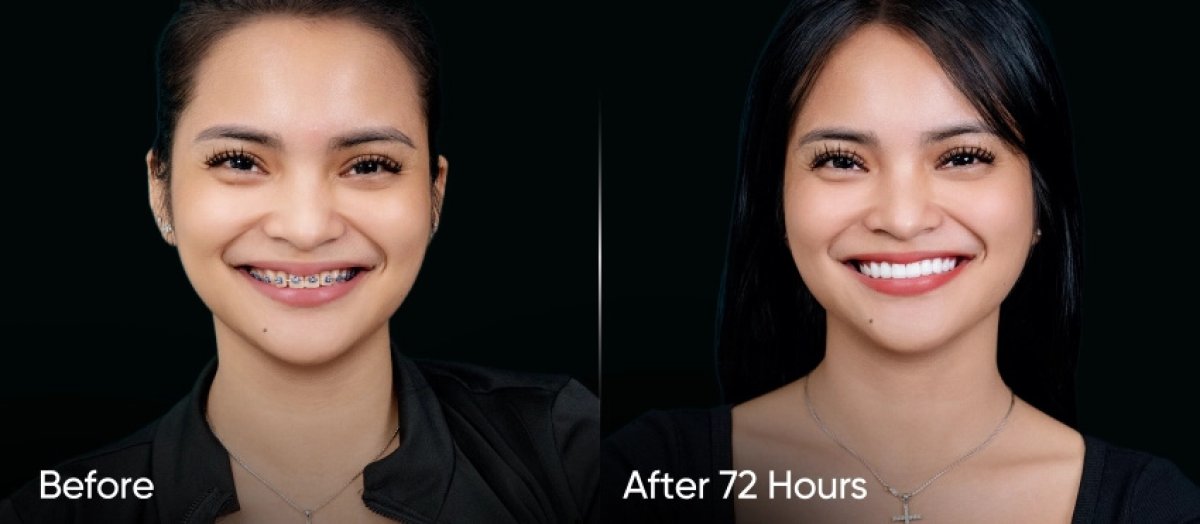 Resultado antes y después de retirar brackets: dientes rectos y sonrisa mejorada en 72 horas
