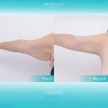Before and after arm lift (brachioplasty) results at Wansiri Hospital, improved arm contour