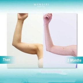 Before and after arm lift (brachioplasty) results at Wansiri Hospital, improved arm contour