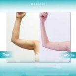 Before and after arm lift (brachioplasty) results at Wansiri Hospital, improved arm contour