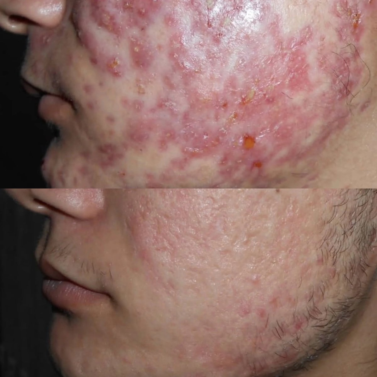 نتائج علاج ندبات حب الشباب قبل وبعد في ARS Clinic – تحسن ملمس البشرة