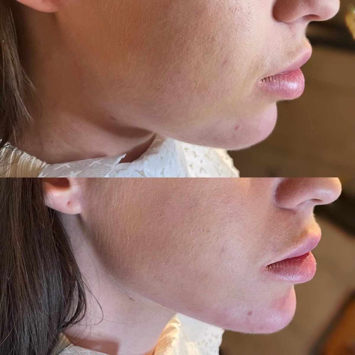 Antes y después de perfilado de mandíbula en ARS Clinic, mejora del contorno facial