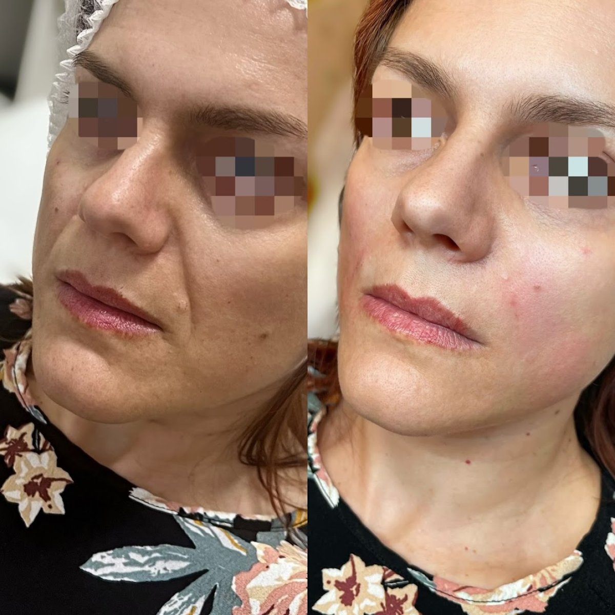 Resultados antes y después de lifting facial sin cirugía en ARS Clinic – piel más suave