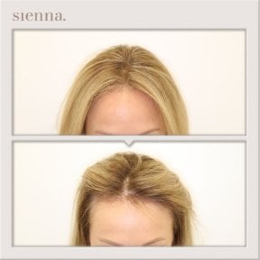 Результати пересадки волосся до і після в Sienna Clinic, покращена густота волосся