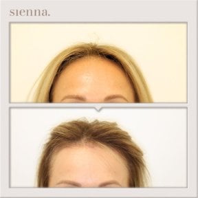 Результати до і після підтяжки обличчя в Sienna Clinic, покращення чола та лінії волосся