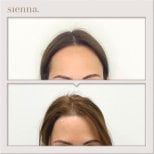Результати підтяжки обличчя до і після в Sienna Clinic, покращення чола та лінії волосся