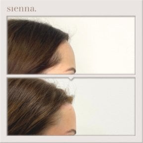 Результати до і після підтяжки обличчя в Sienna Clinic, покращення чола та лінії волосся