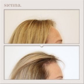 Результати до і після підтяжки обличчя в Sienna Clinic, помітне омолодження та ліфтинг