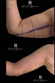 Before and after arm lift (brachioplasty) results at Turan Turan Health Group, improved contour
