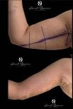 Before and after arm lift (brachioplasty) results at Turan Turan Health Group, improved contour