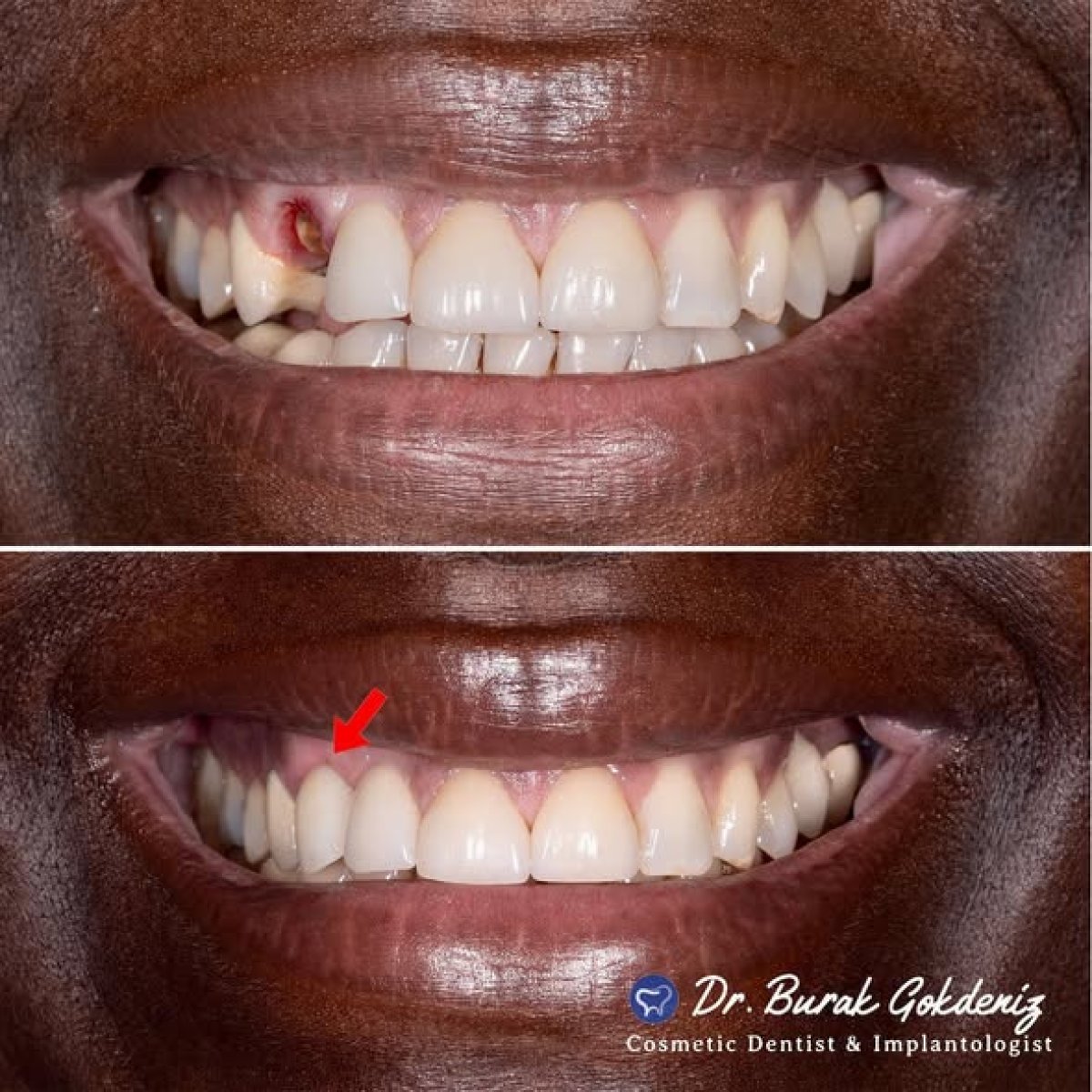 نتائج قبل وبعد زراعة الأسنان مع التاج في DENTAFLY DENTAL IMPLANT & SMILE STUDIO
