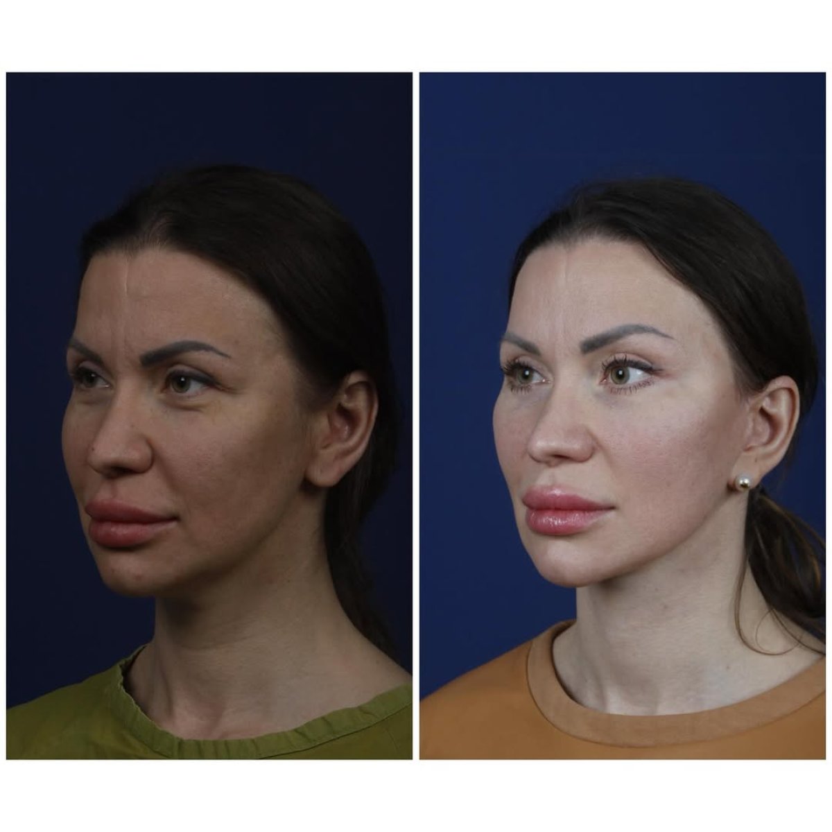 Resultados de lifting facial antes y después en National Prime Hospital, rejuvenecimiento visible