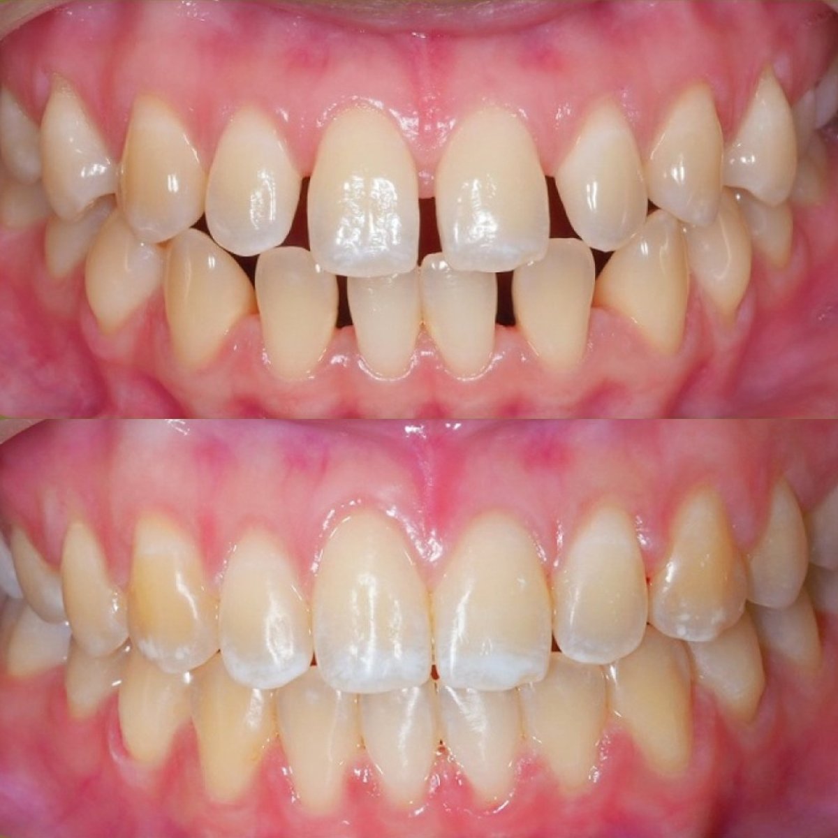 نتائج تقويم الأسنان قبل وبعد في Stellar Dental – تحسين ترتيب الأسنان والابتسامة