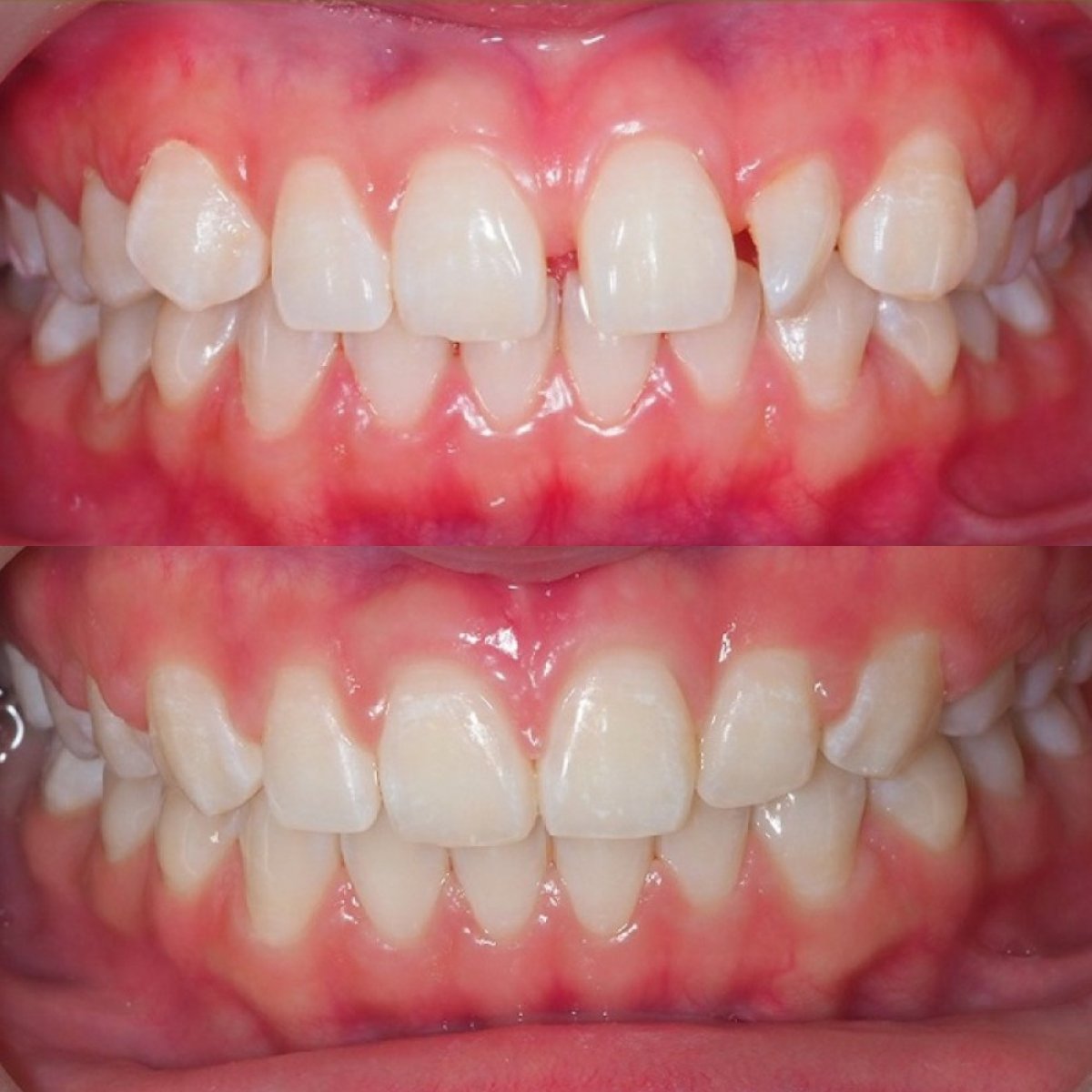 Resultados antes y después de brackets autoligables en Stellar Dental – alineación dental mejorada