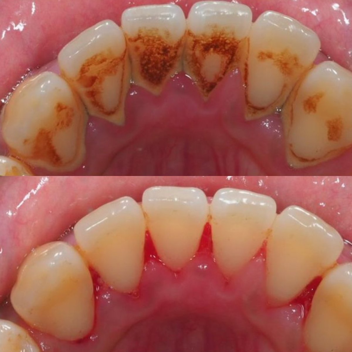 نتائج قبل وبعد تنظيف الأسنان (إزالة الجير) في Stellar Dental – إزالة الترسبات