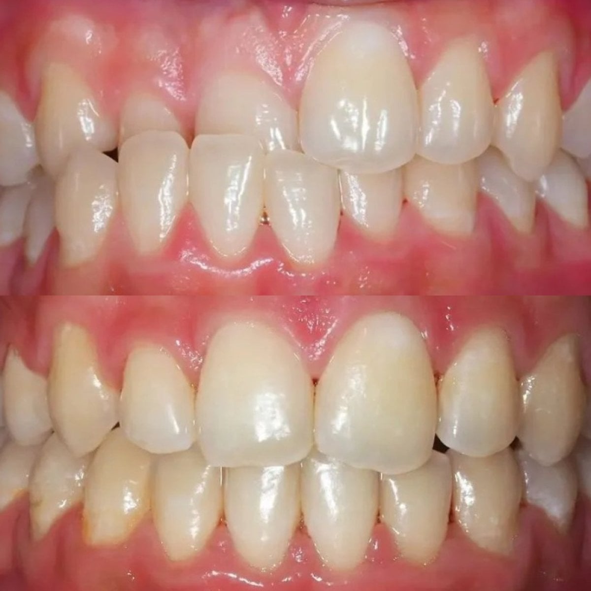 نتائج قبل وبعد تقويم الأسنان الذاتي في Stellar Dental – تحسين انتظام الأسنان