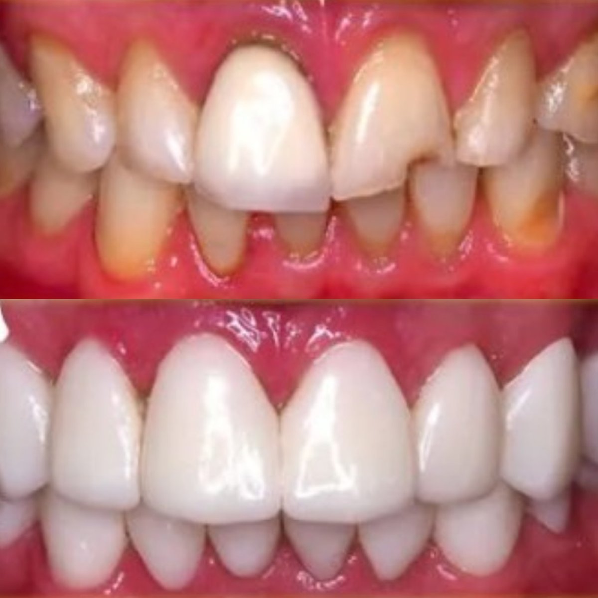 نتائج تبييض الأسنان قبل وبعد في Stellar Dental – أسنان أكثر بياضًا ولمعانًا