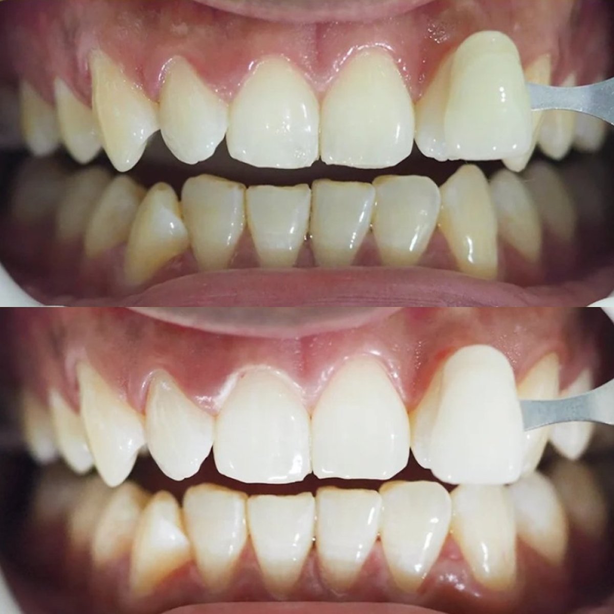 Resultados de blanqueamiento dental antes y después en Stellar Dental – sonrisa más brillante