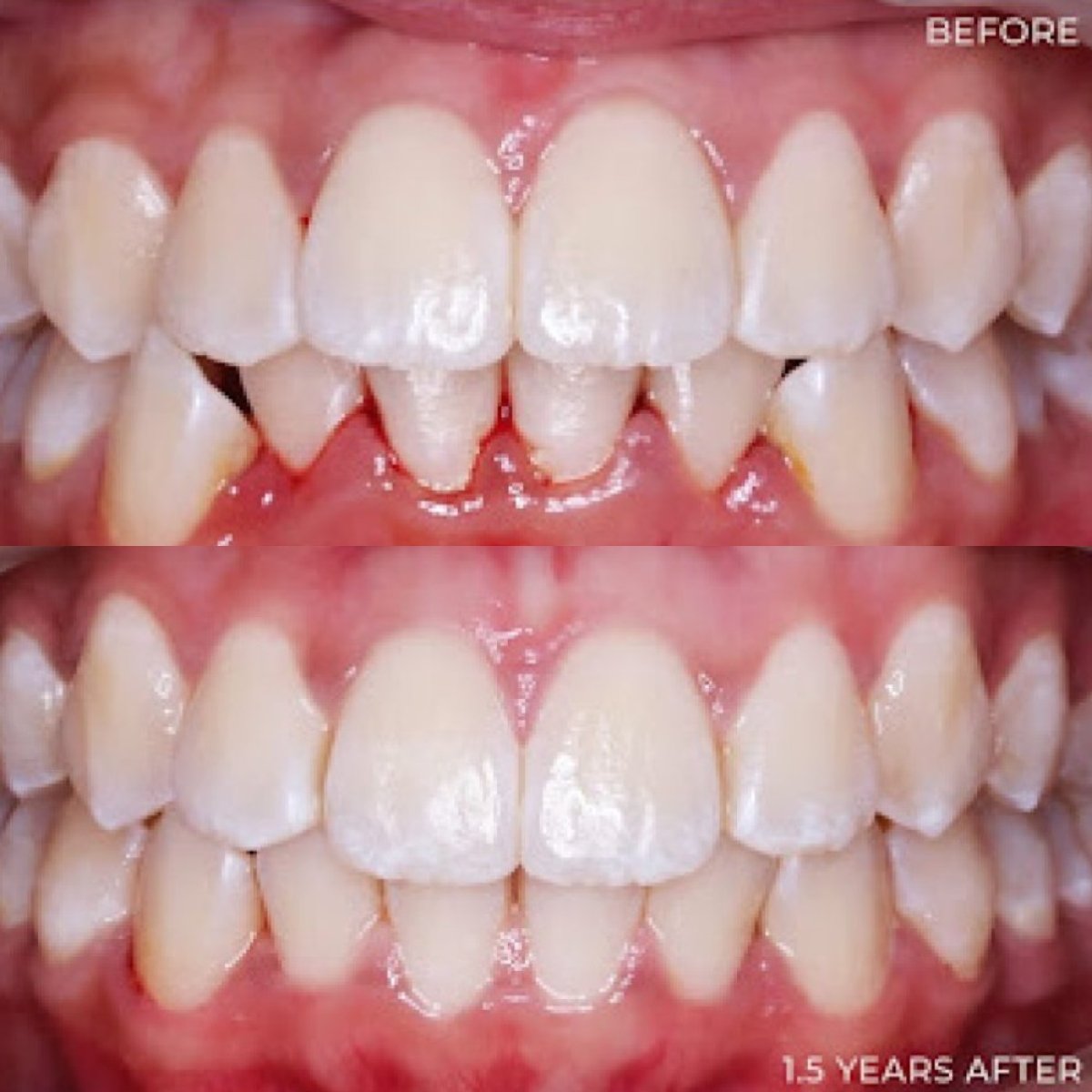 نتائج قبل وبعد تقويم Invisalign في Stellar Dental – تحسين اصطفاف الأسنان خلال 1.5 سنة