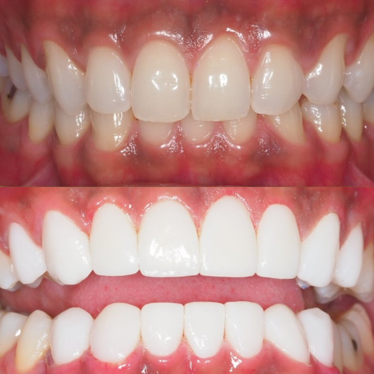 Resultados antes y después de carillas de porcelana en Stellar Dental – sonrisa mejorada