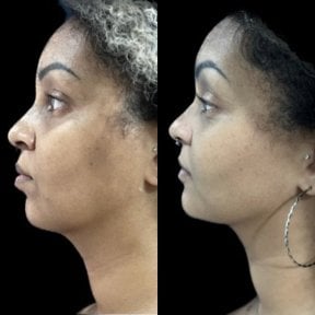 before-after photo neck-liposuction