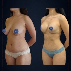 before-after photo breast-augmentation