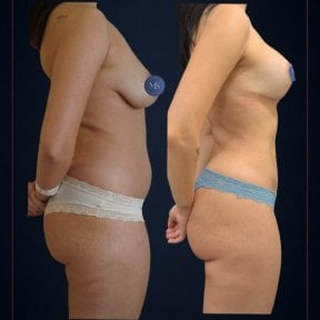 before-after photo breast-augmentation