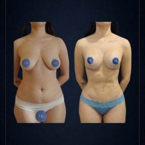 before-after photo breast-augmentation