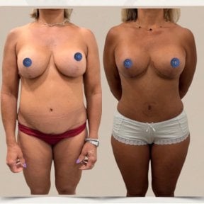 before-after photo breast-augmentation