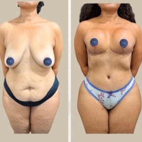 before-after photo breast-augmentation