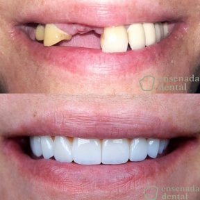 Efekt przed i po implantach All-on-4 w Ensenada Dental – pełna odbudowa uśmiechu